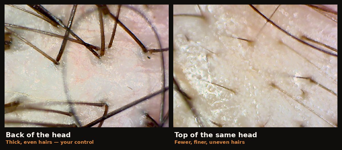 Two 50x magnified scalp images from the same person on the same day: thick, even hairs at the back of the head beside fewer, finer, uneven hairs on top.