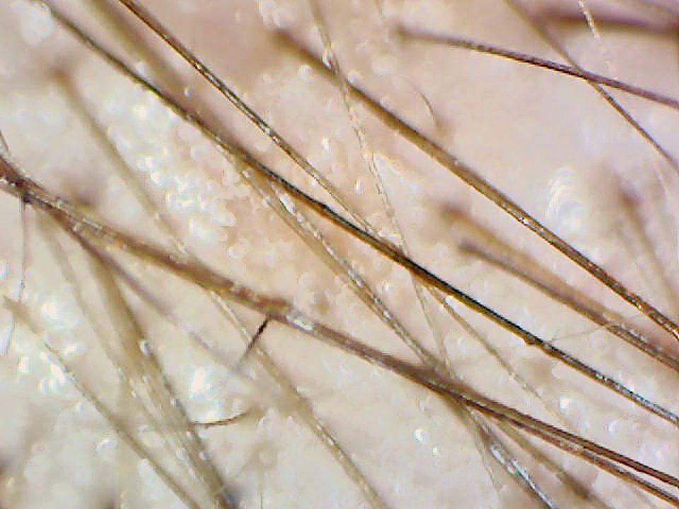 50x magnified image of a scalp area with a mix of fine and thicker hairs.