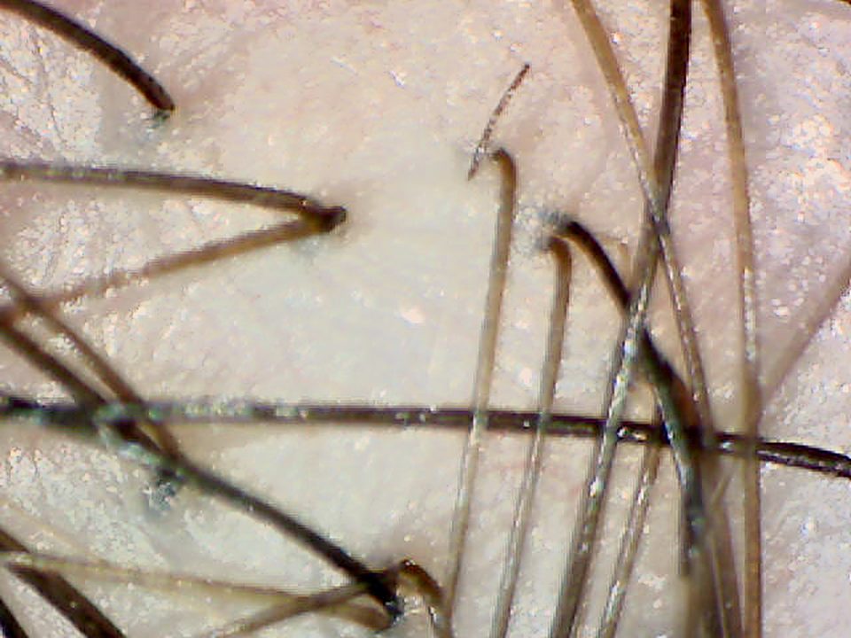 50x magnified image of donor hair showing follicular units with one, two and three hairs.