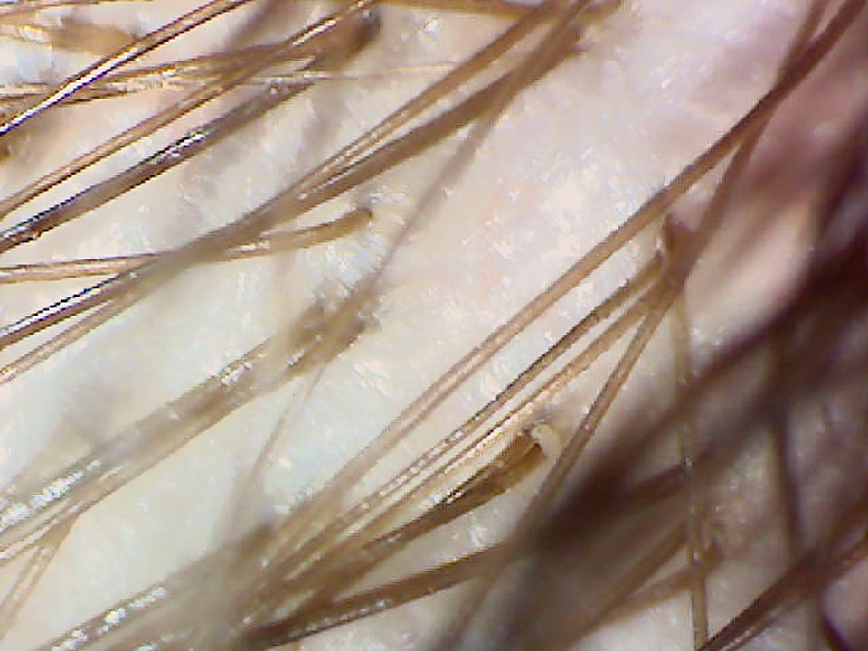 50x magnified image of full-thickness hair at the back of the scalp.