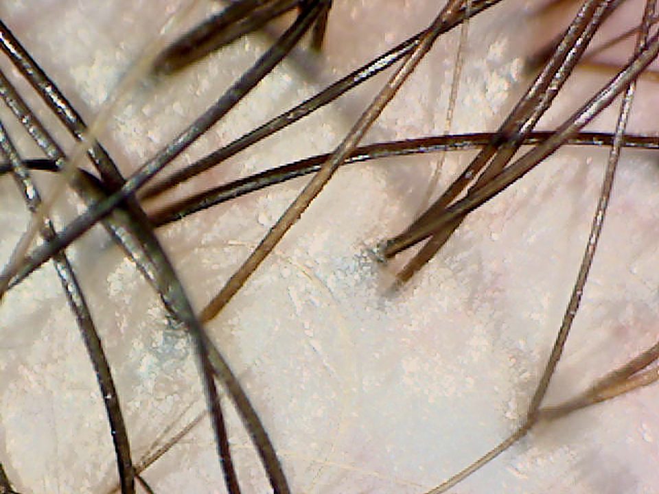 50x magnified scalp image showing hairs emerging from follicles.