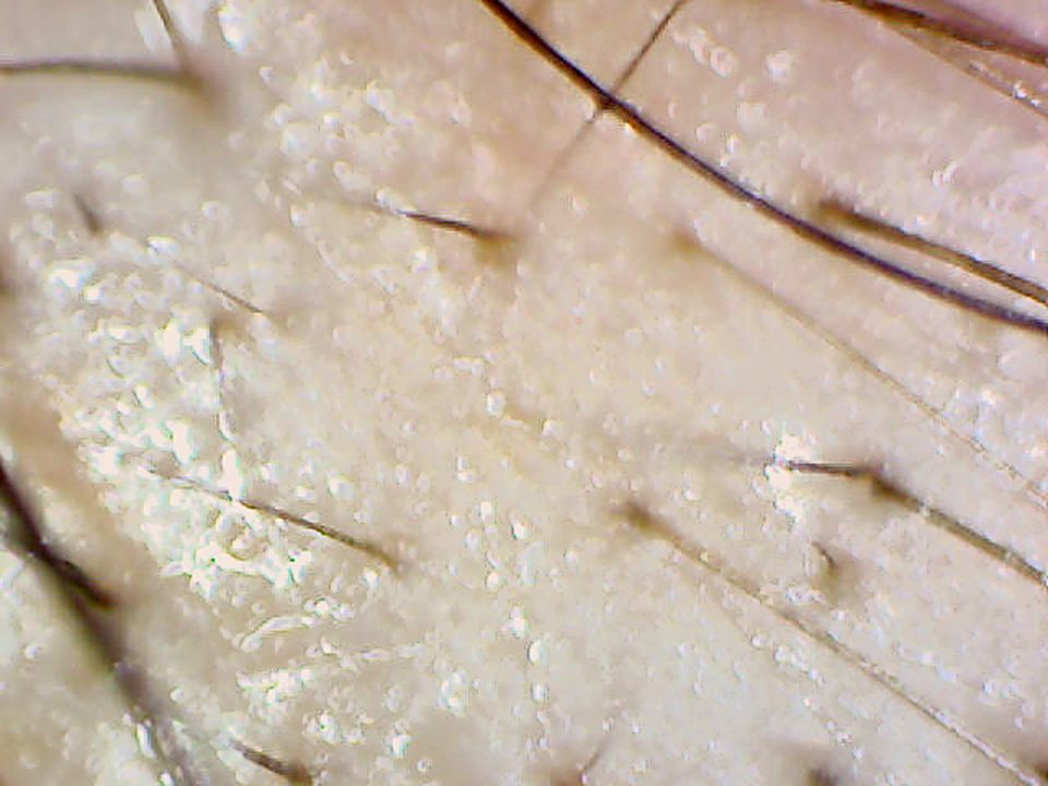 50x magnified image of a thinning scalp area with sparse, fine hairs.