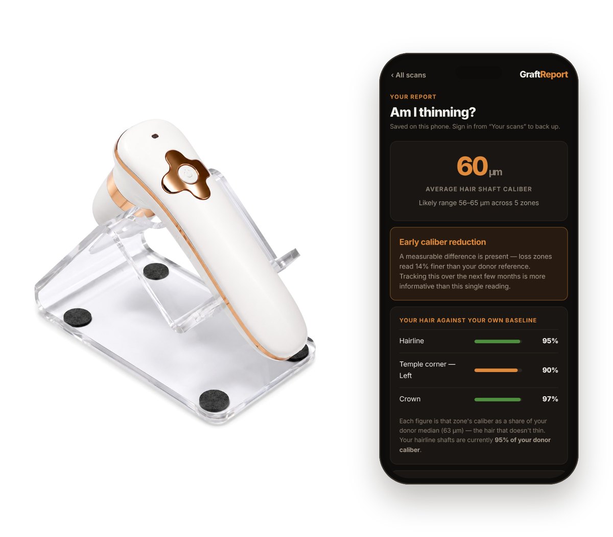 The GraftReport scanner on its stand next to a phone showing a GraftReport report with hair caliber and each zone compared with the donor baseline.