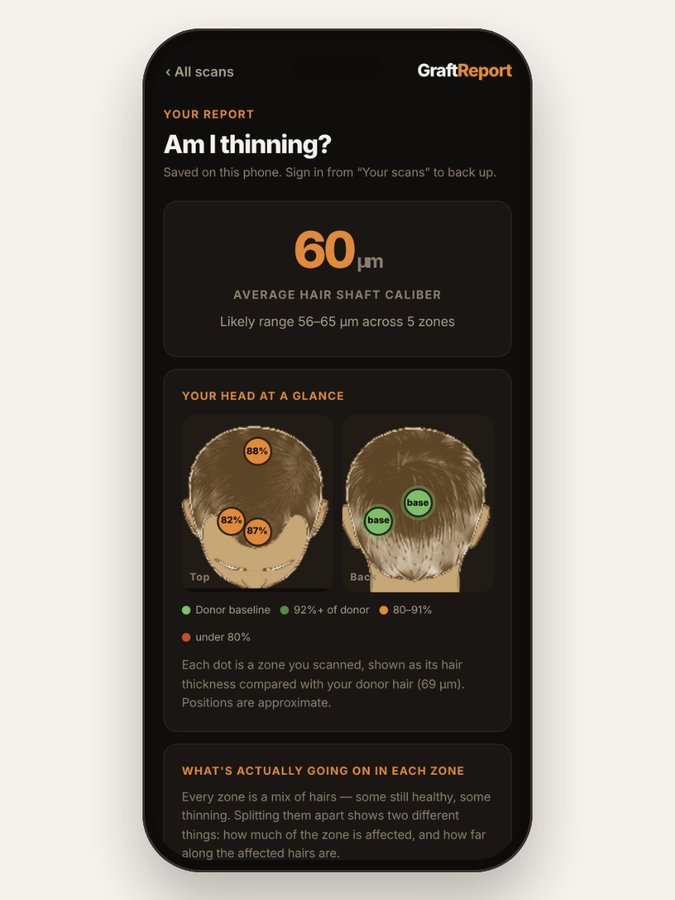 Report screen: your head at a glance, with each scanned zone shown as a percentage of your donor hair thickness.